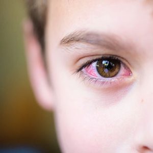 Αλλεργική επιπεφυκίτιδα: Κόκκινα ερεθισμένα μάτια που τρέχουν, σημάδι ότι ήρθε η άνοιξη! 